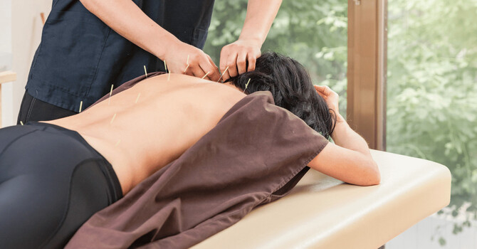 Acupuncture